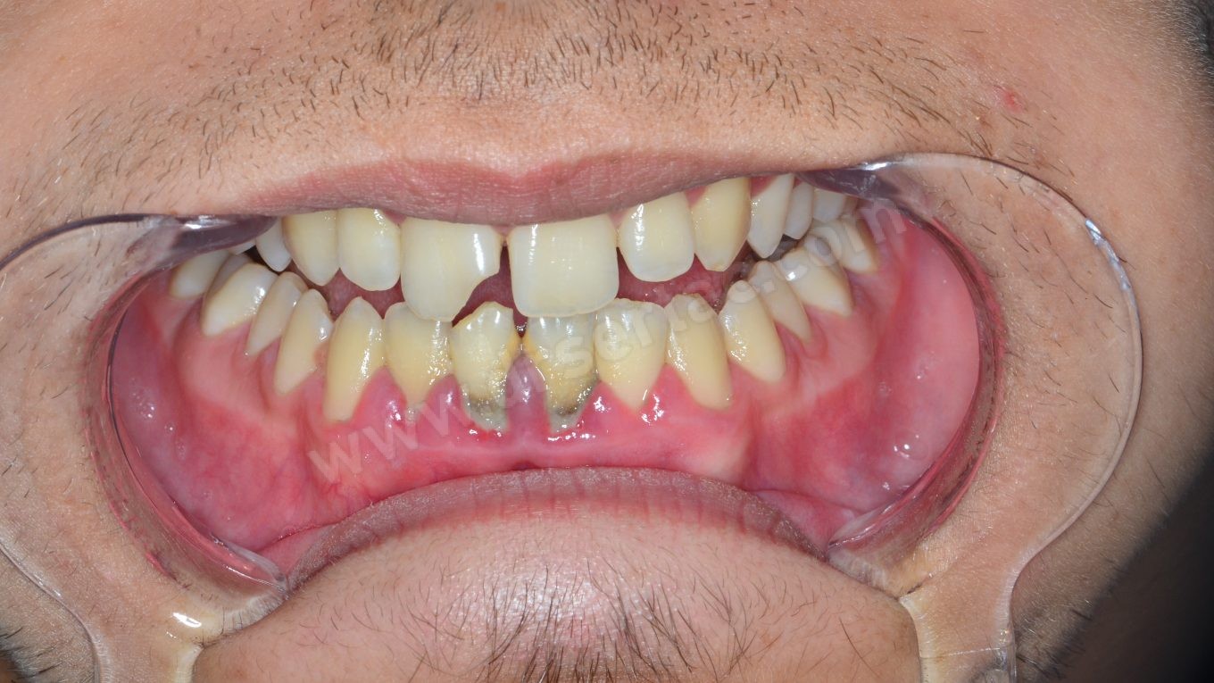 diş taşı periodontoloji diş eti çekilmesi