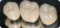 Porselen diş metal altyapı