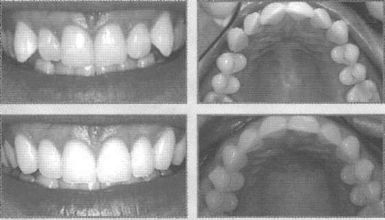 Orthero invisalign Caligner markaları ile şeffaf plak ile telsiz ortodonti uygulaması mimkün